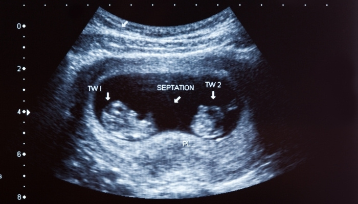 An ultrasound image of twins at 10 weeks.