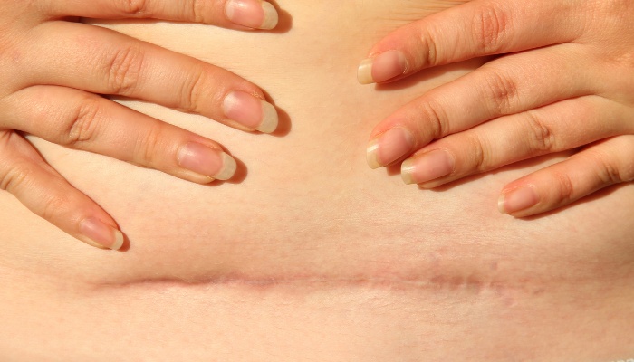 A woman's hand exposing her c-section scar and belly pooch after pregnancy.